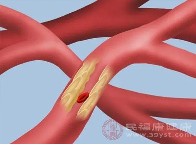 腦血管也會因脂質(zhì)沉積出現(xiàn)動脈粥樣硬化，導(dǎo)致腦血管狹窄或堵塞