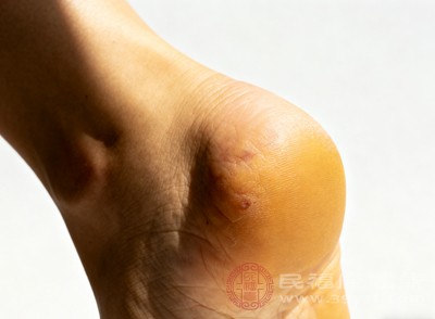 胆汁淤积会导致胆汁无法正常排出，反流入血液中。胆汁中的胆盐等成分会刺激皮肤，引起皮肤瘙痒，同时也会使皮肤颜色发黄，包括脚底