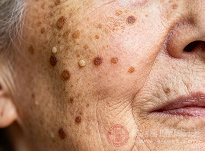 黑色素代谢紊乱加剧,更容易出现色素沉着,进而促进老人斑的形成 黑色素代谢紊乱加剧,更容易出现色素沉着,进而促进老人斑的形成
