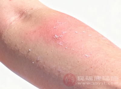 救命！秋燥把人折磨惨？鼻痒皮裂还干咳？1杯茶+2个穴位，快速驱燥超省心