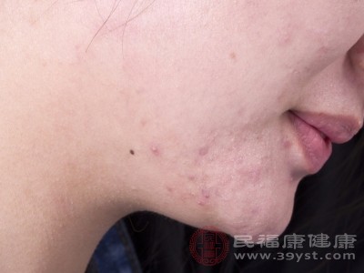 臉蛋冒痘別抓狂 揪出背后“搗蛋鬼”