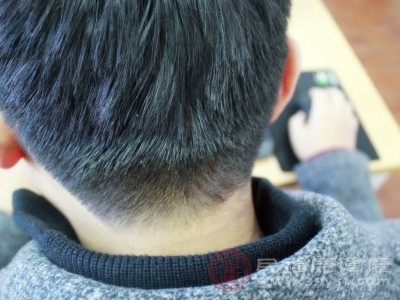 后腦勺長痘痘是“鬧哪樣” 背后原因大揭秘 速來圍觀