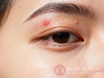 细菌更容易侵入毛囊，引发炎症和痘痘