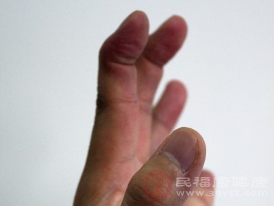 会引发周围神经病变