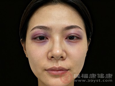 双眼皮淤血.jpg 双眼皮淤血.jpg