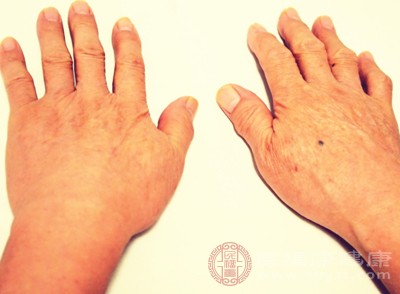 類風(fēng)濕關(guān)節(jié)炎是一種自身免疫性疾病，主要侵犯關(guān)節(jié)滑膜，導(dǎo)致關(guān)節(jié)疼痛、腫脹、僵硬