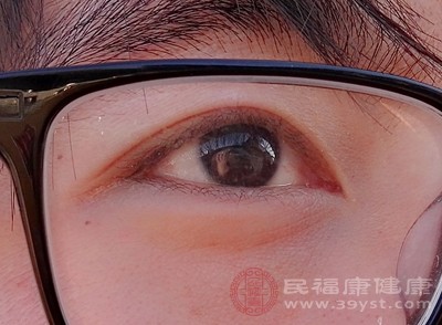 初期,眼尾会出现红肿、疼痛的硬结,随着病情发展,硬结会逐渐化脓 初期,眼尾会出现红肿、疼痛的硬结,随着病情发展,硬结会逐渐化脓