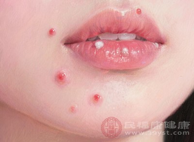 面对红肿硬大痘痘，盲目处理可能适得其反，科学的护理才能帮助其安全消退