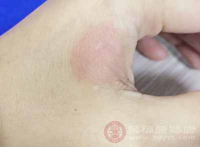 对于轻度的油烫伤,可以在冷却和保护创面后,涂抹一些烫伤药膏 对于轻度的油烫伤,可以在冷却和保护创面后,涂抹一些烫伤药膏