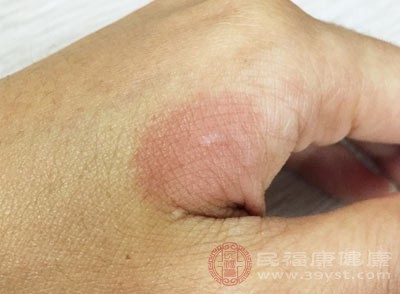 在处理他们的烫伤时,要更加谨慎 在处理他们的烫伤时,要更加谨慎