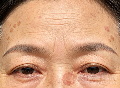 老年斑就是皮肤老化导致色斑形成的典型例子