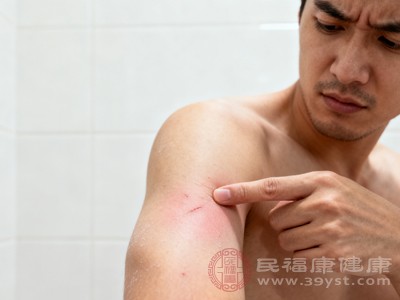 若疙瘩伴随明显干燥脱屑，瘙痒在洗澡后加重，多为乏脂性湿疹