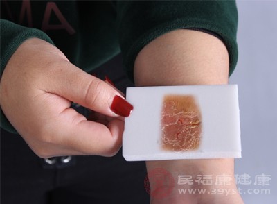 湿疹的皮疹边界通常不清晰，与周围正常皮肤逐渐过渡，这与一些边界清晰的皮肤病（如体癣）有明显区别