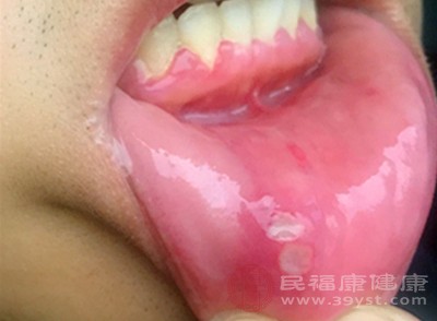 虽然口腔溃疡多表现为圆形或椭圆形的浅表溃疡，但初期可能以小水疱形式出现，随后水疱破裂形成溃疡，伴随剧烈疼痛