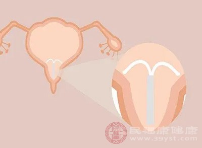 别让节育环“超期服役” 长期不取的这些危害 女性一定要了解