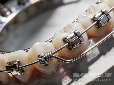 钢丝牙套适用范围广泛 钢丝牙套适用范围广泛
