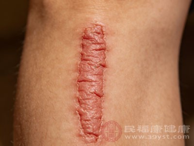 饮食在刀口增生的消除中起着重要作用 饮食在刀口增生的消除中起着重要作用