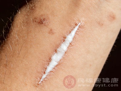 增生疤痕别嚣张 科学方法助你击退小凸起