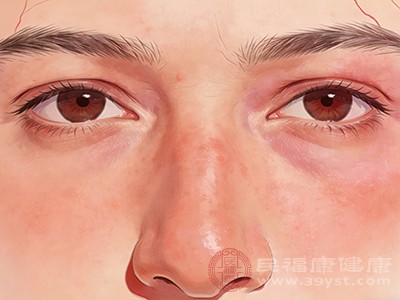 玫瑰痤疮是一种常见的慢性皮肤病