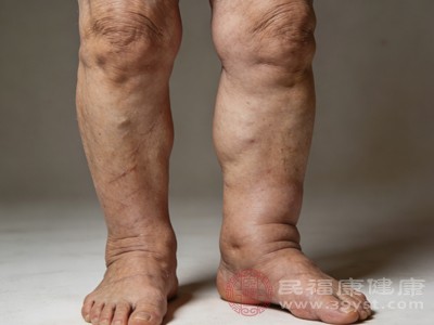 根据检查结果,在医生指导下对心血管、肾脏、肝脏等原发疾病进行规范治疗,随着原发疾病的控制,腿肿症状也会逐渐缓解 根据检查结果,在医生指导下对心血管、肾脏、肝脏等原发疾病进行规范治疗,随着原发疾病的控制,腿肿症状也会逐渐缓解