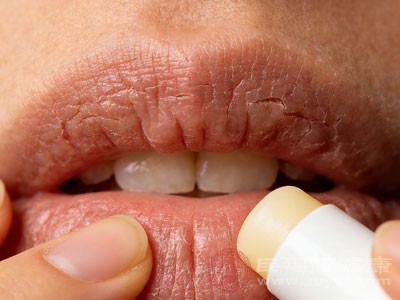 含酒精的润唇膏是常见的“隐形刺激物”