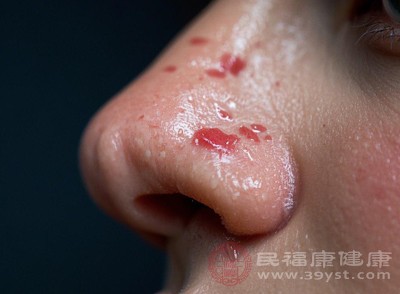 血液在鼻部皮肤聚集