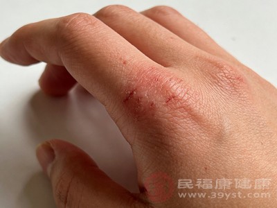 冬天手脚冻僵后，不少人会立刻把手脚放到暖气片上烘烤、靠近火炉取暖，或是用滚烫的热水泡脚泡手