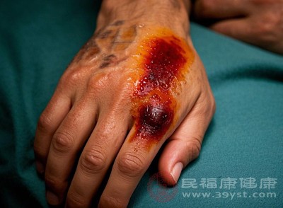 应激状态，如手术、创伤、烧伤等