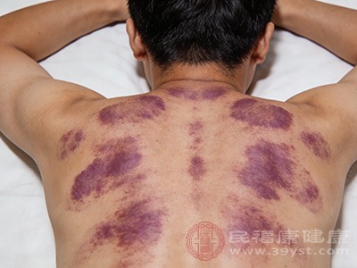 两次开背至少间隔3-5天,让皮肤和组织充分修复 两次开背至少间隔3-5天,让皮肤和组织充分修复