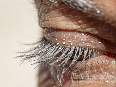 老年人的倒睫常与眼睑松弛相关