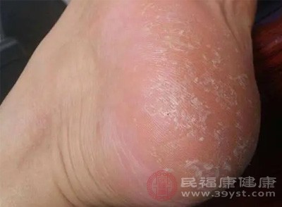 跑步时某只脚总是先以脚跟外侧着地