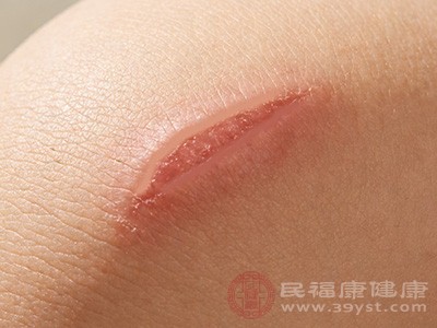 受伤后正确护理很重要