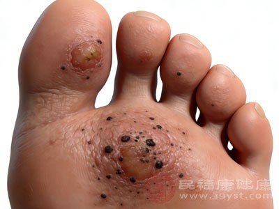 明显的疼痛症状