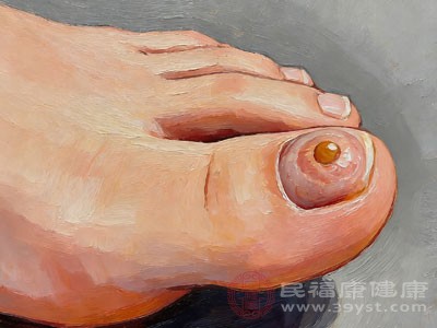 鸡眼or跖疣 教你看穿脚部小麻烦的真面目