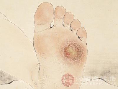 跖疣的外观则与鸡眼有很大区别