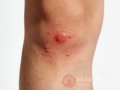 若小疙瘩经过2-3周护理后仍无改善，或数量越来越多，可能是皮肤病的表现，需就医排查