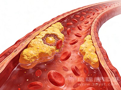 血管斑块能逆转！这样做可缩小甚至消失~