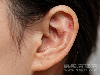 外耳道炎是指外耳道皮肤的炎症 外耳道炎是指外耳道皮肤的炎症