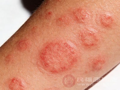 无需对荨麻疹产生恐惧和排斥