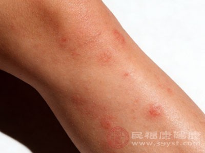 荨麻疹的自白 我只是皮肤小脾气 不搞传染那一套