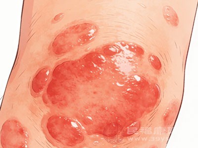 要判断荨麻疹是否会传染 要判断荨麻疹是否会传染