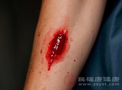 用医用棉签蘸取适量碘伏