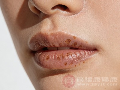 上唇部位虽然不是肝斑常见的出现部位