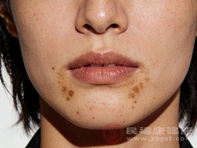 下颌部位也是肝斑可能出现的区域之一