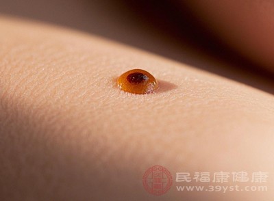 肉痣通常由皮肤中的色素细胞或结缔组织增生形成，表现为高出皮肤表面、质地柔软或稍硬的隆起物，颜色多为褐色、黑色或肤色