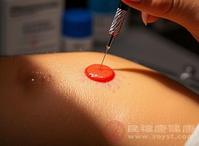 肉痣是否可以点掉，首先要经过专业医生的评估