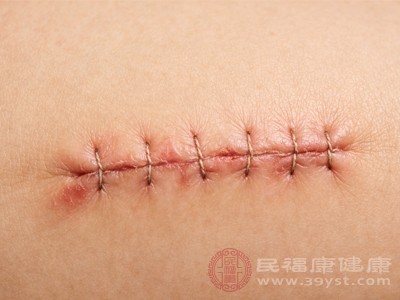 剖腹产刀口碰水别着急 这些情况不能碰 小心引发感染