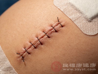 剖腹产刀口碰水时间并非固定统一，需结合刀口愈合情况和医生建议，同时注意碰水时的护理细节