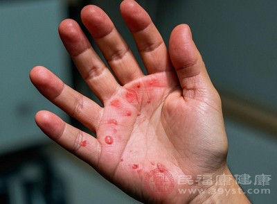 较小水泡（直径＜0.5厘米）无需特殊处理，保持皮肤清洁干燥，避免摩擦挤压，让其自然吸收