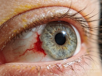 糖尿病、凝血功能障碍等全身性疾病，会影响身体的凝血机制或血管健康，也可能导致眼睛出现红血块